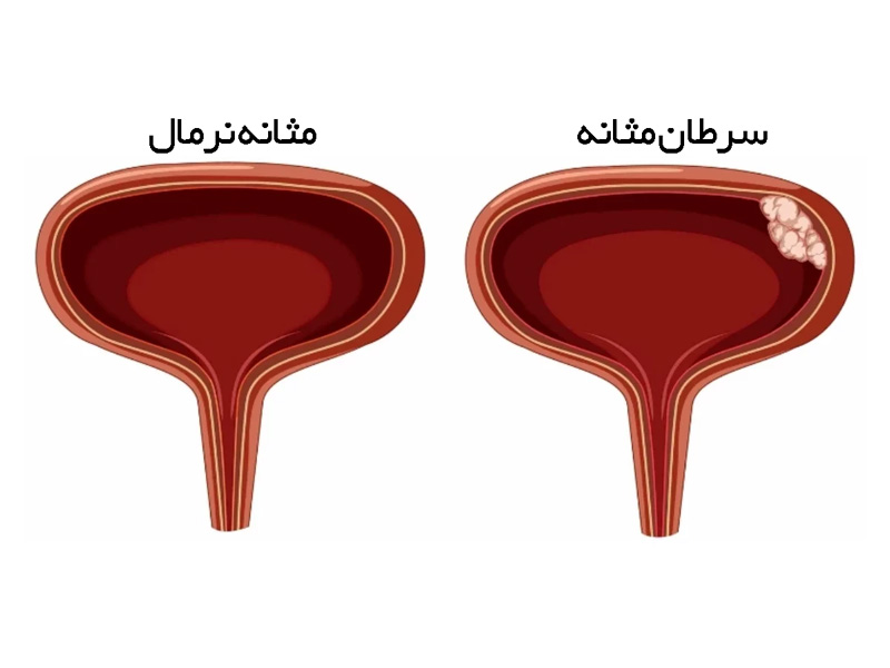 راهنمای بیماران درشناسایی علایم وپیشگیری سرطان های ریه ،معده ،کولون ، روده بزرگ،پروستات ،مثانه