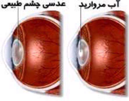 راهنمای آموزشی آب مروارید