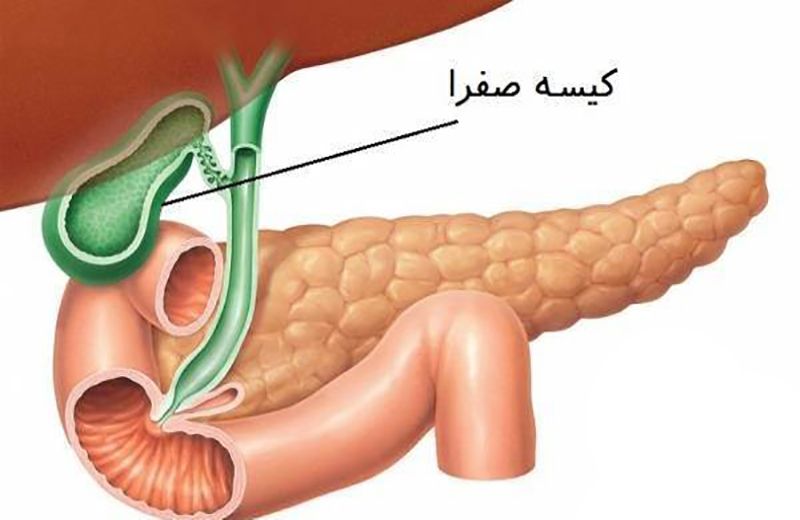 راهنمای آموزشی بیماری کیسه صفرا